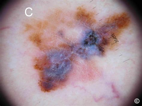 dermnet melanoma|melanoma dermoscopy images.